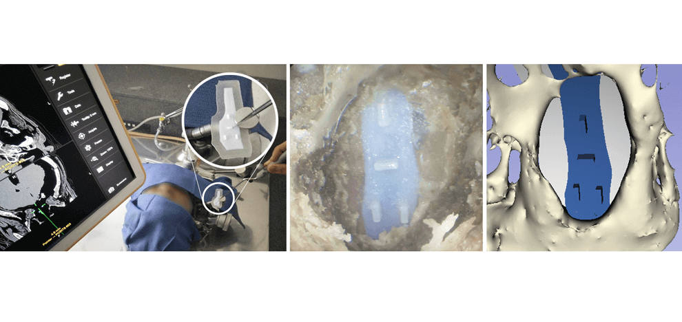 3d-printing-intraoperative-neuronavigation-tailoring-skull-base-reconstruction-after-extended-endoscopic-endonasal-surgery-3 3d-printing-intraoperative-neuronavigation-tailoring-skull-base-reconstruction-after-extended-endoscopic-endonasal-surgery-3